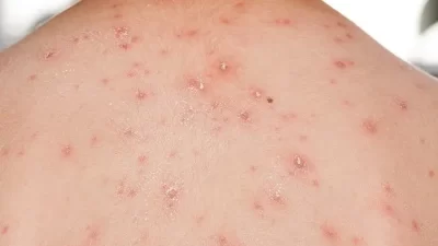 WHO Tetapkan Wabah Cacar Monyet Jadi Status Darurat Kesehatan Global