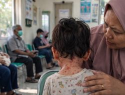 Kasus Campak Indonesia 2026 Tembus Ribuan, Penularannya Sulit Dikendalikan